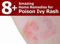 Image result for Poison Ivy Rash Remedy