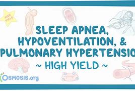 Image result for Obstructive Sleep Apnea and Hypertension