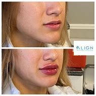 Image result for Versa Lip Filler