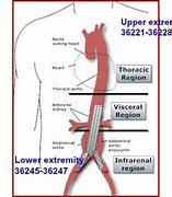 Image result for Selective Catheter Placement From Brachial Approach