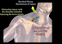 Image result for Brachial Plexus Fall Injury