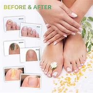 Image result for Nail Fungus Pen