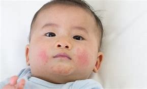 Image result for Baby Eczema Hands