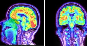 Image result for Pet Scan Glucose