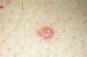 Image result for Small Red Circular Rash On Skin