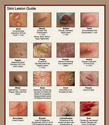 Image result for Soap Skin Rash