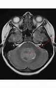 Image result for Medulloblastoma Location Diagram