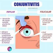 Image result for Conjuntivitis