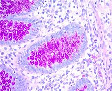 Image result for Periodic acid-Schiff Stain