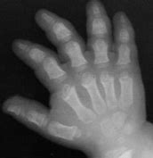 Image result for Trident Hand Achondroplasia