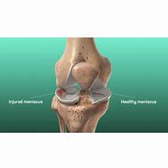 Image result for Meniscus Stress