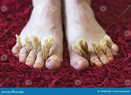 Image result for Toes with Fungus