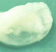 Image result for Cyst White Paste