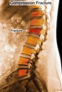 Image result for Imagees Compression Fracture of Lumbar Vertebrae