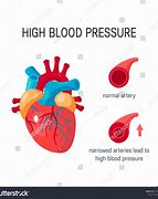 Image result for High Blood Pressure Arteries