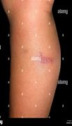 Image result for Lower Leg Pustules