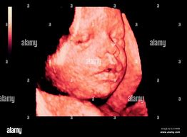 Image result for 3 Month Pregnancy Ultrasound