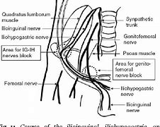 Image result for Ilioinguinal Nerve Block