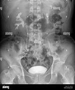 Image result for Kidney On X-ray