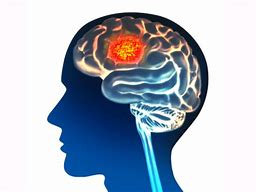 Image result for Brain Tumor Clip Art