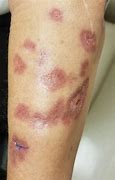 Image result for Skin Atrophy Diagram