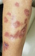 Image result for Sclerotic Atrophy of Skin