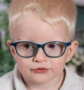 Image result for albino child eyes