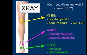 Image result for Ottawa Knee