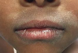 Image result for Eczema On Black Skin with Grey Colour