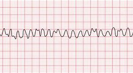 Image result for Ventricular Fibrillation Symptom