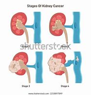 Image result for Kidney Cancer Tumor