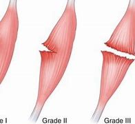 Image result for Micro Tears in Muscle Fiber Under Microscopes