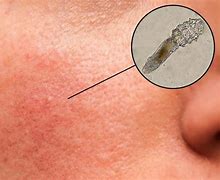 Image result for Mites Found On Human Face