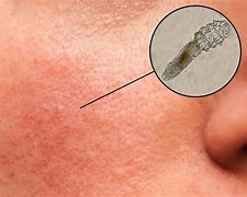 Image result for Mites On Face