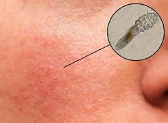 Image result for Killing Demodex Mites On Face