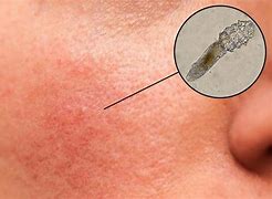 Image result for Mites On Face Skin Infection