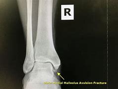 Image result for Avulsion Fracture