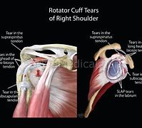 Image result for Supraspinatus and Infraspinatus Tendinopathy