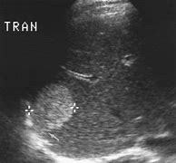 Image result for Hemangioma Ultrasound