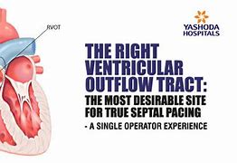 Image result for Right Ventricular Outflow Tract