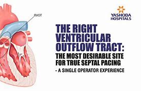 Image result for Left Ventricular Outflow Tract Stroke Volume