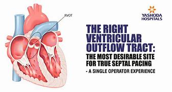 Image result for Anatomical Site of Left Ventricular Outflow Tract