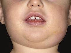 Image result for Mumps Drawing