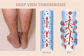 Image result for Thrombotic Veins