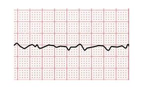 Image result for Ventricular Fibrillation EKG Examples