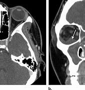 Image result for Subperiosteal Abscess Orbital Cellulitis