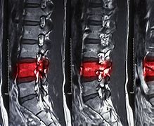 Image result for Compression Fracture Lumbar Surgery