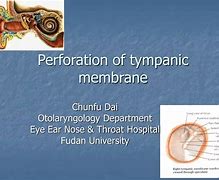 Image result for Tympanic Perforation