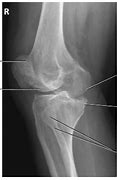 Image result for Knee Lateral Rotation