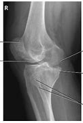 Image result for PA Oblique Lateral Rotation Knee